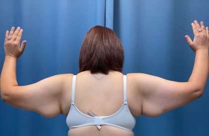 Arm Lift Before & After Patient #2498