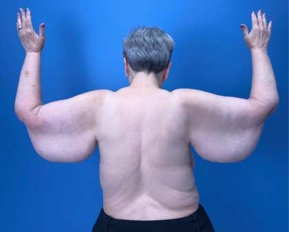 Arm Lift Before & After Patient #2503