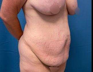 Tummy Tuck Before & After Patient #482
