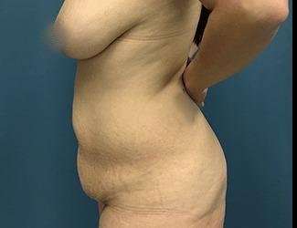 Tummy Tuck Before & After Patient #493