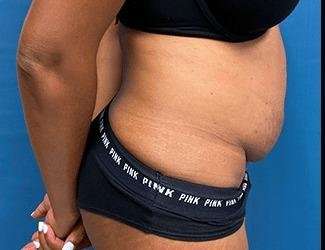 Tummy Tuck Before & After Patient #504