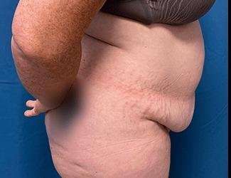 Tummy Tuck Before & After Patient #515