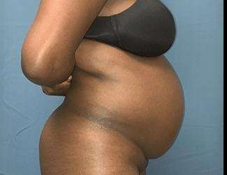 Tummy Tuck Before & After Patient #528