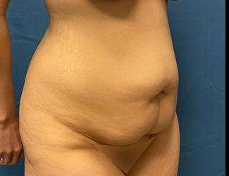 Tummy Tuck Before & After Patient #535