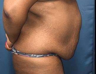 Tummy Tuck Before & After Patient #546