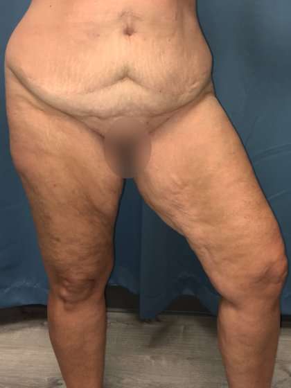 Thigh Lift Before & After Patient #553