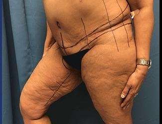 Thigh Lift Before & After Patient #558