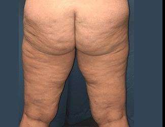 Thigh Lift Before & After Patient #563