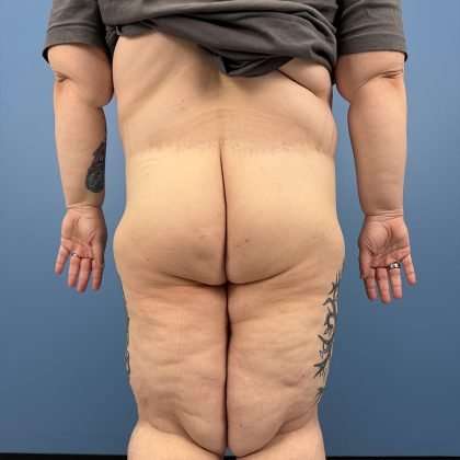 Thigh Lift Before & After Patient #579