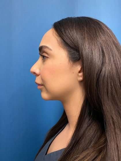 Submentoplasty Before & After Patient #597
