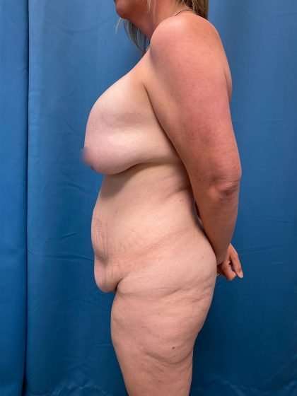 Tummy Tuck Before & After Patient #293