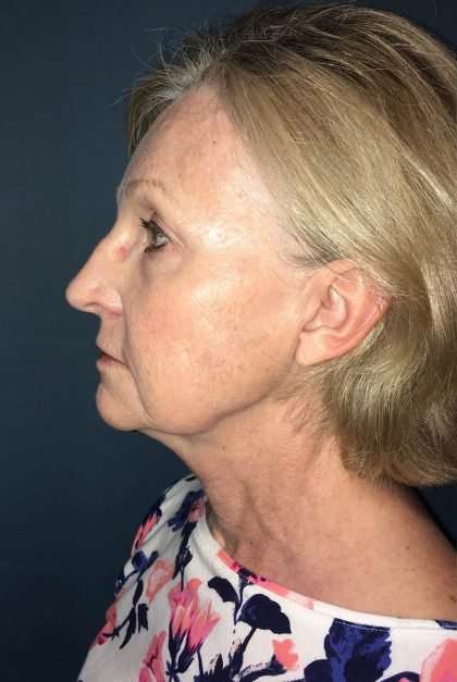 Submentoplasty Before & After Patient #654
