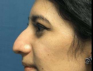 Rhinoplasty Before & After Patient #667