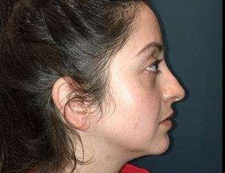 Rhinoplasty Before & After Patient #680