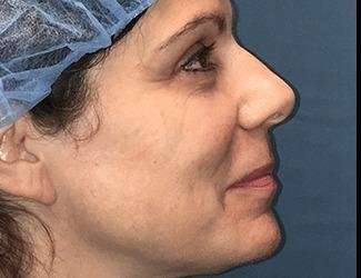 Rhinoplasty Before & After Patient #693