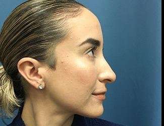 Rhinoplasty Before & After Patient #706