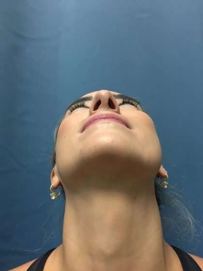 Rhinoplasty Before & After Patient #715