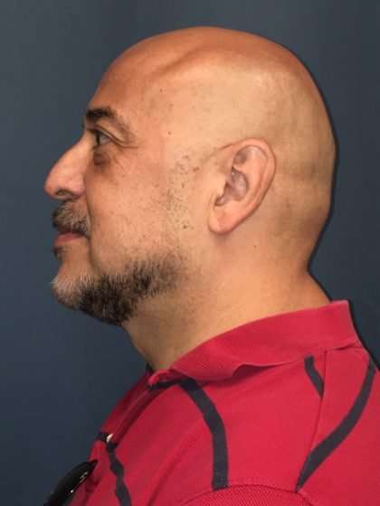 Rhinoplasty Before & After Patient #722