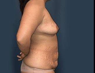 Mommy Makeover Before & After Patient #743
