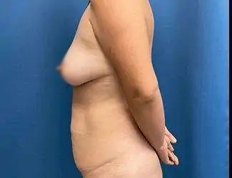 Mommy Makeover Before & After Patient #866