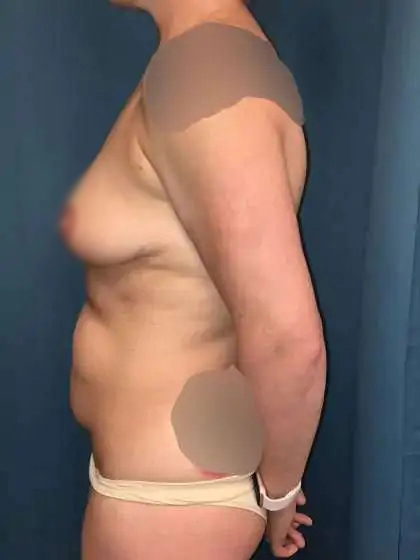 Mommy Makeover Before & After Patient #904