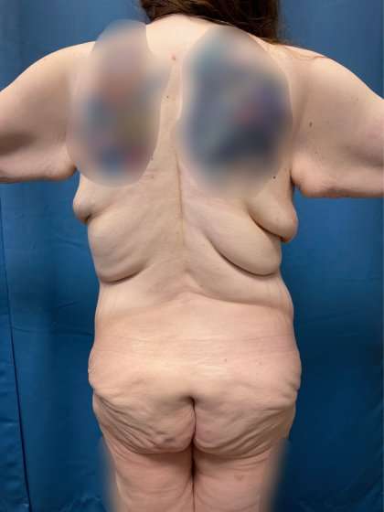 Massive Weight Loss Before & After Patient #986