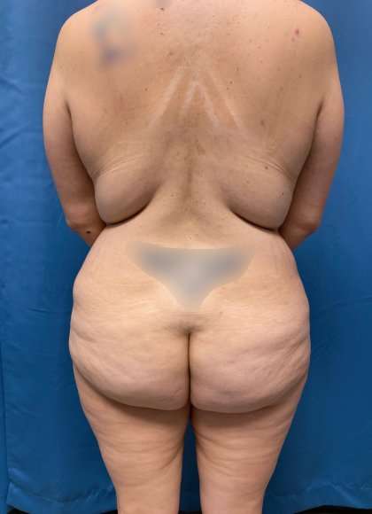 Lower Body Lift Before & After Patient #1008