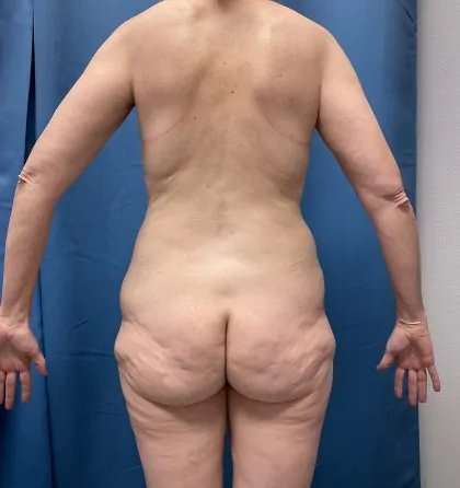 Lower Body Lift Before & After Patient #1034