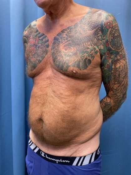 Tummy Tuck Before & After Patient #322