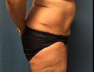 Lower Body Lift Before & After Patient #1047