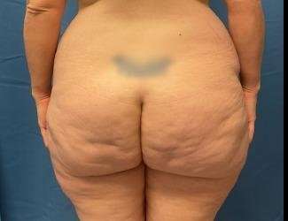 Lower Body Lift Before & After Patient #1050