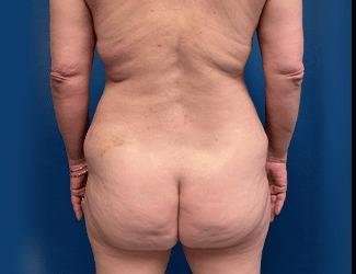 Lower Body Lift Before & After Patient #1094