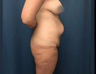 Lower Body Lift Before & After Patient #1114