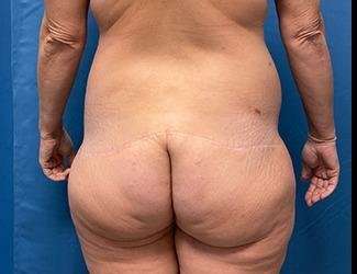 Lower Body Lift Before & After Patient #1127