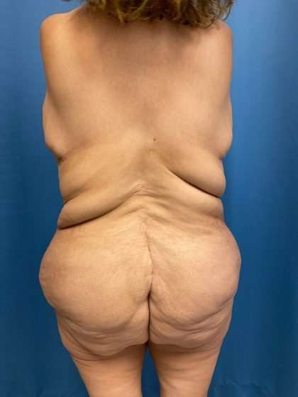 Lower Body Lift Before & After Patient #1141