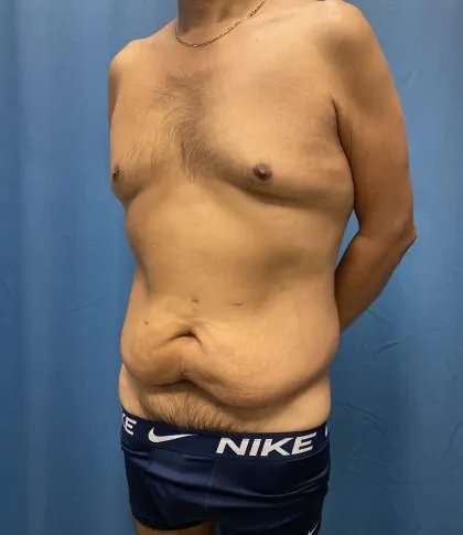 Tummy Tuck Before & After Patient #333