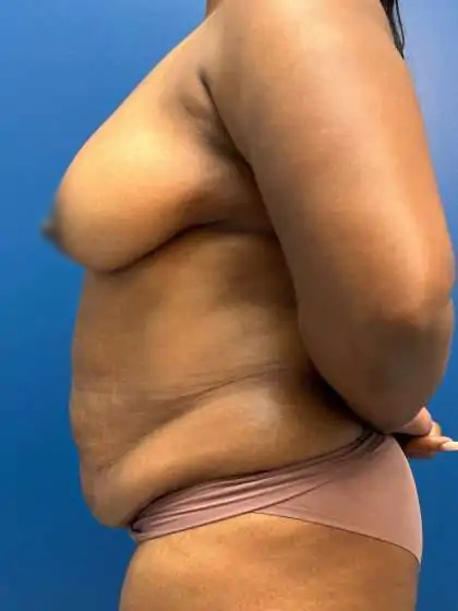 Lower Body Lift Before & After Patient #1154
