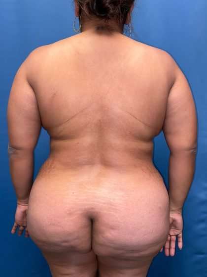 Lower Body Lift Before & After Patient #1161