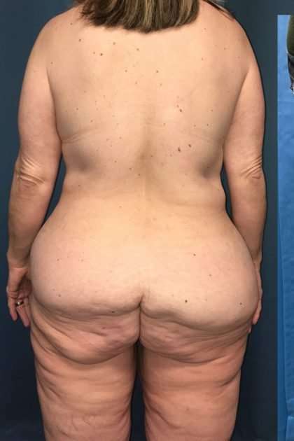 Lower Body Lift Before & After Patient #1174