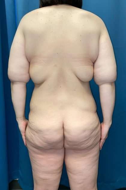 Lower Body Lift Before & After Patient #1187