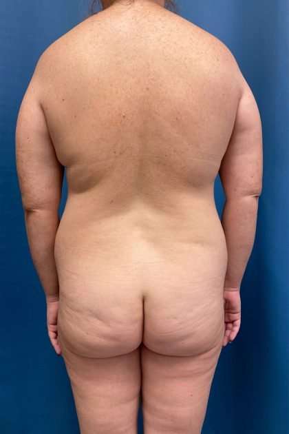 Lower Body Lift Before & After Patient #1200