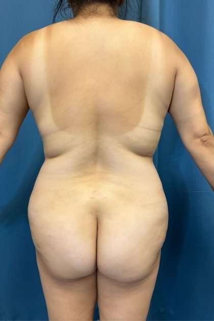 Lower Body Lift Before & After Patient #1213