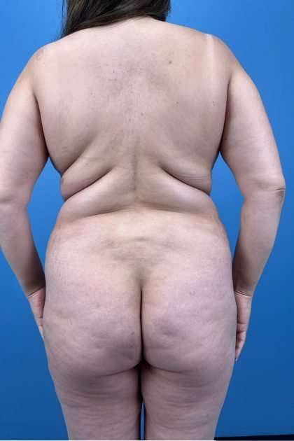 Lower Body Lift Before & After Patient #1226