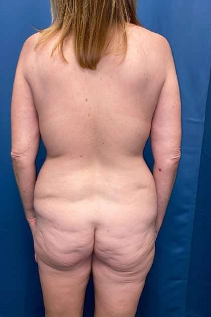 Lower Body Lift Before & After Patient #1239