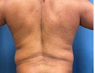Liposuction Before & After Patient #1246