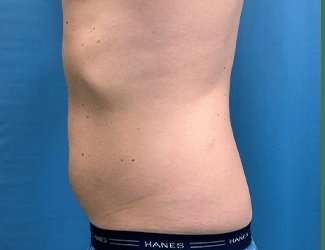 Liposuction Before & After Patient #1257