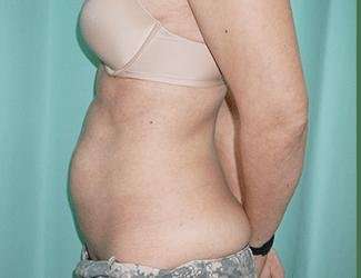 Tummy Tuck Before & After Patient #340