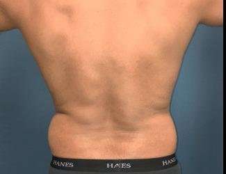Liposuction Before & After Patient #1262