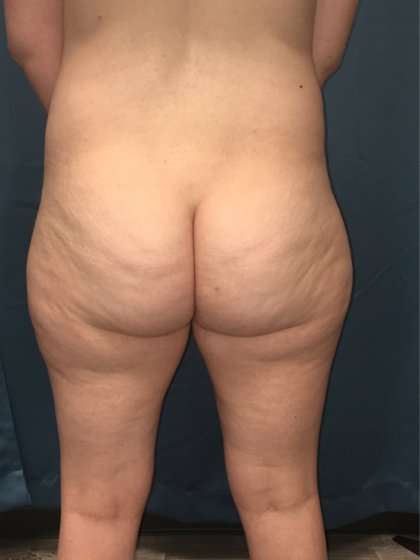 Liposuction Before & After Patient #1268