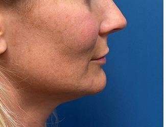 Lip Lift Before & After Patient #1289